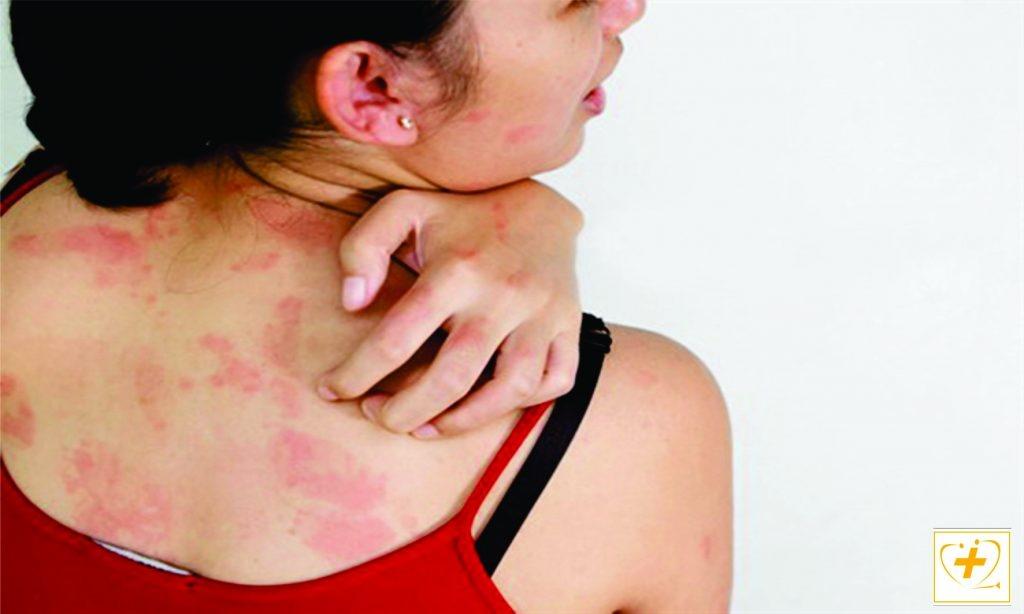 triệu chứng giun đũa chó